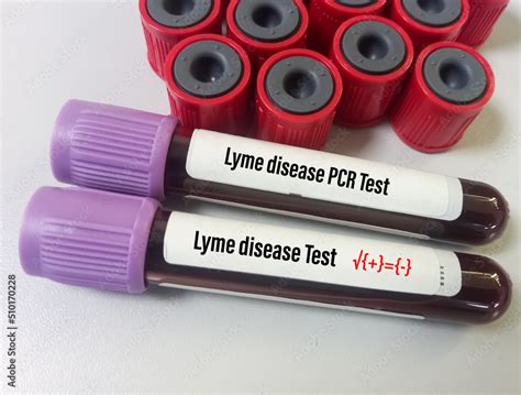 lyme serology blood test bottle|testing for lyme disease.